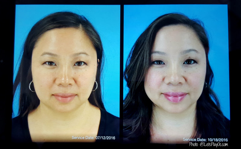 After 2 Treatments of Kybella Update #CosmetiCareMoms